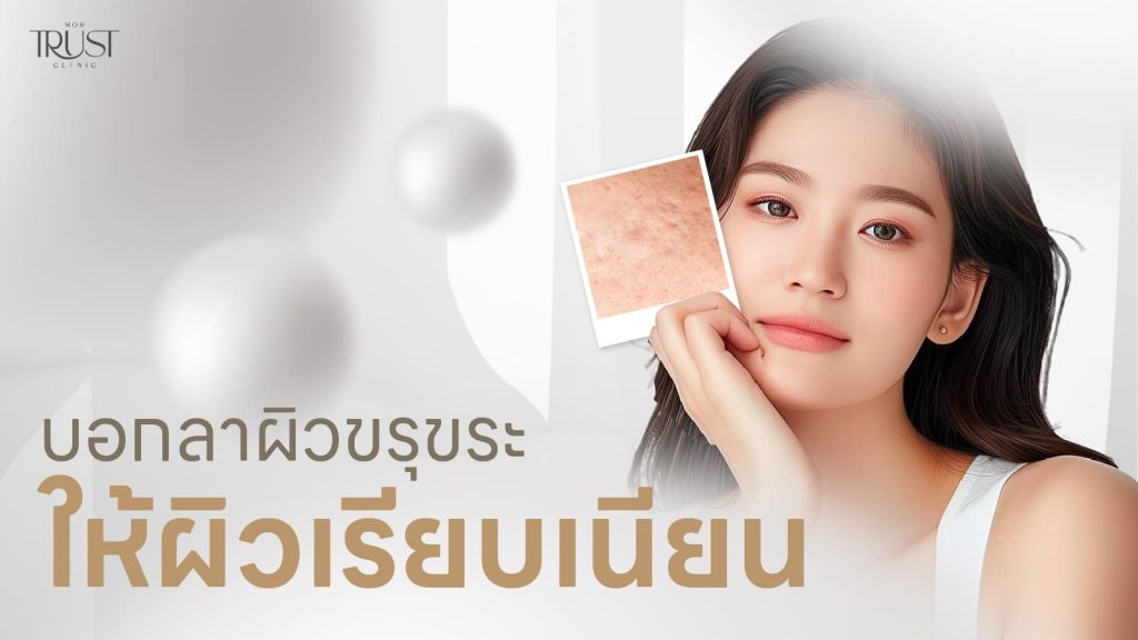 รักษาหลุมสิวเชียงใหม่