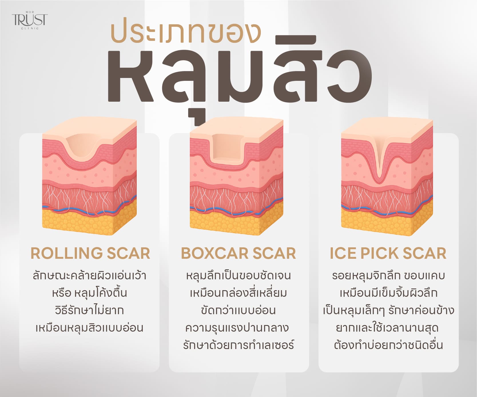 ประเภทหลุมสิว
