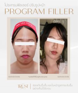 ultraformerเชียงใหม่