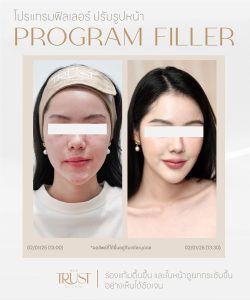 ultraformerเชียงใหม่