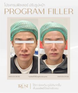 ultraformerเชียงใหม่