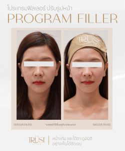 ultraformerเชียงใหม่