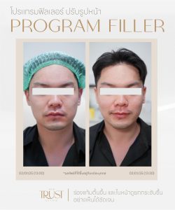 ultraformerเชียงใหม่