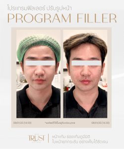 ultraformerเชียงใหม่