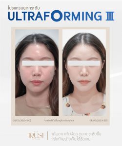 ultraformerเชียงใหม่