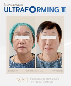 ultraformerเชียงใหม่