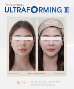 ultraformerเชียงใหม่