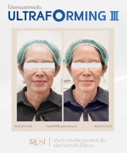 ultraformerเชียงใหม่