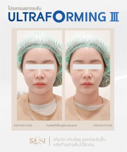 ultraformerเชียงใหม่