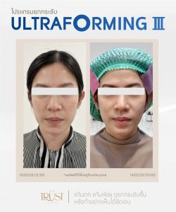 ultraformerเชียงใหม่