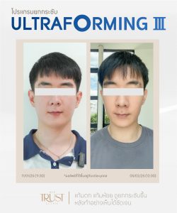 ultraformerเชียงใหม่