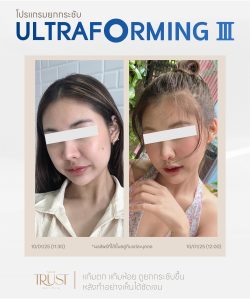ultraformerเชียงใหม่