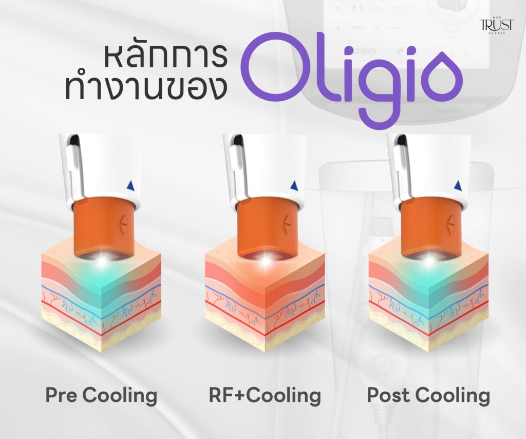 หลักการทำงานของเครื่อง Oligio