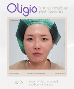 Oligio นวัตกรรมยกกระชับ