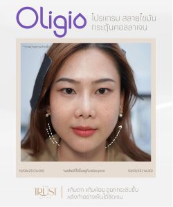 Oligio นวัตกรรมยกกระชับ