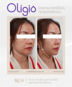 Oligio นวัตกรรมยกกระชับ