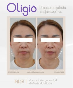 Oligio นวัตกรรมยกกระชับ