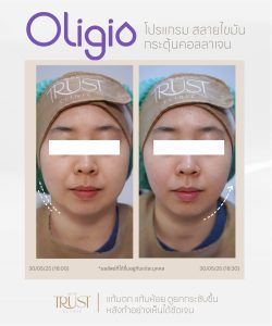Oligio นวัตกรรมยกกระชับ