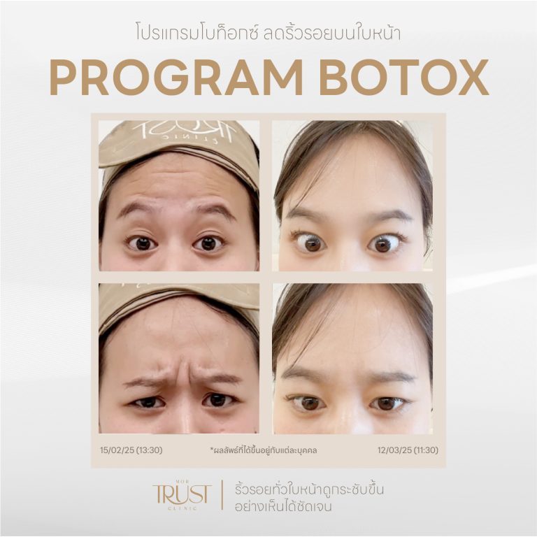 Botox01