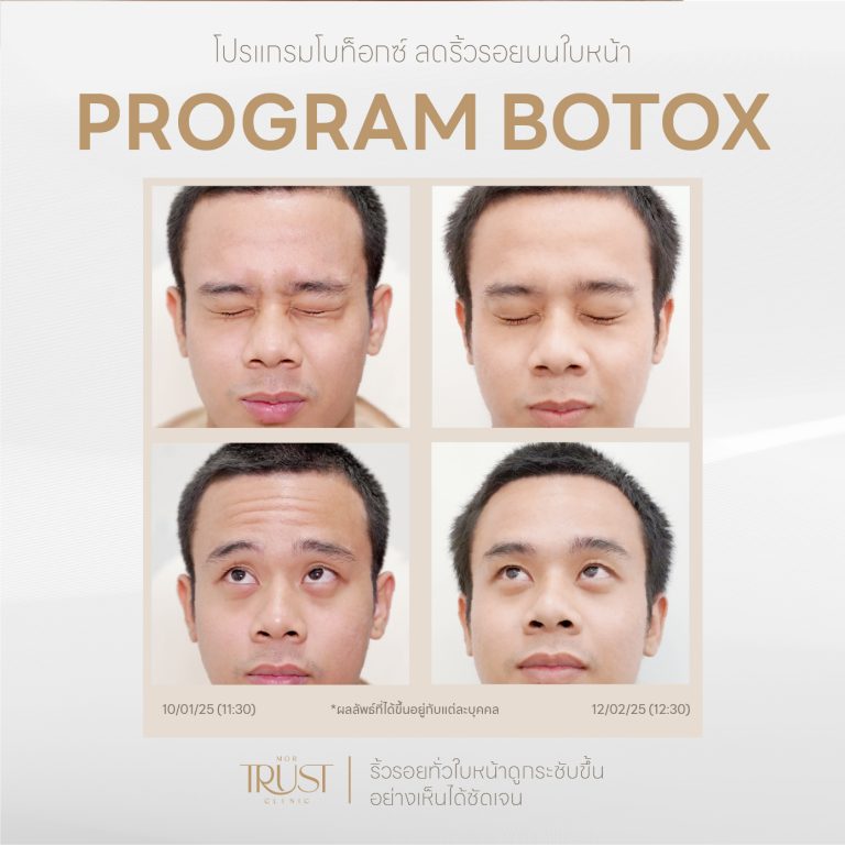 Botox02
