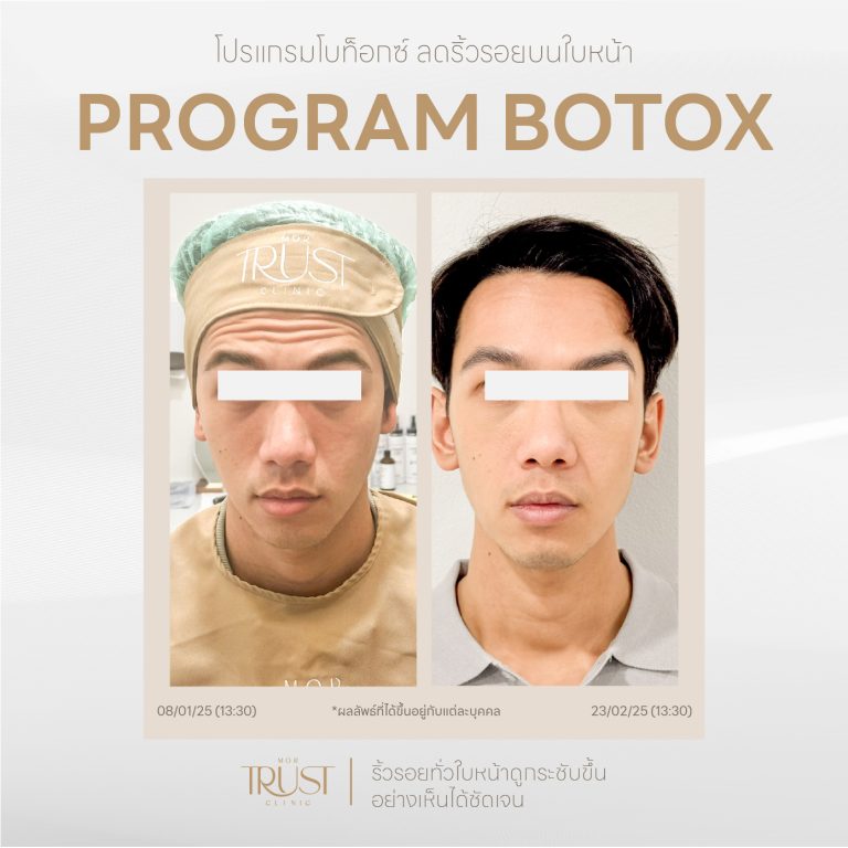Botox03