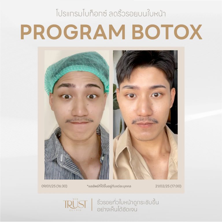 Botox04