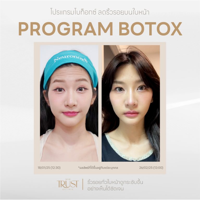Botox05