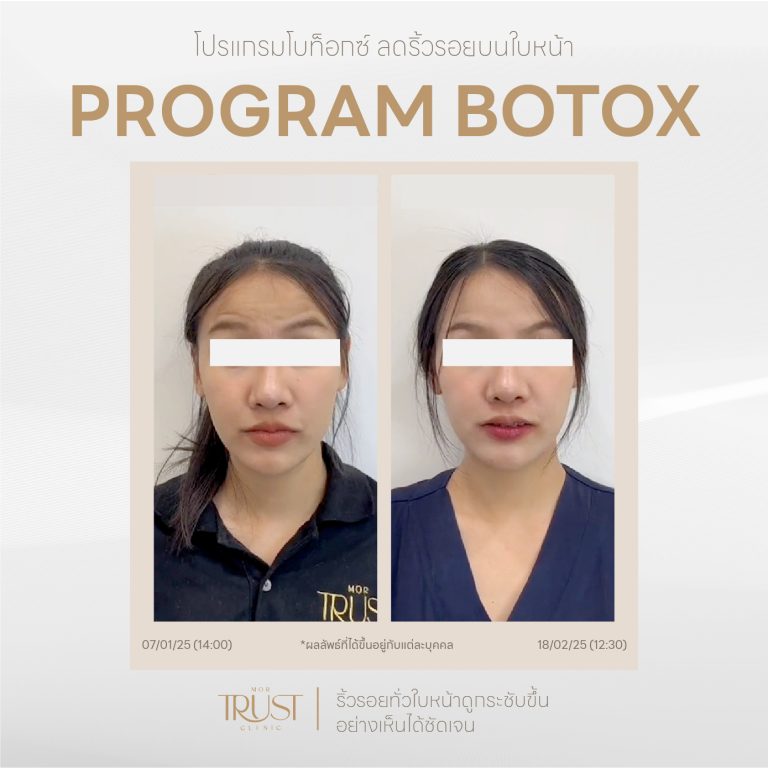Botox06