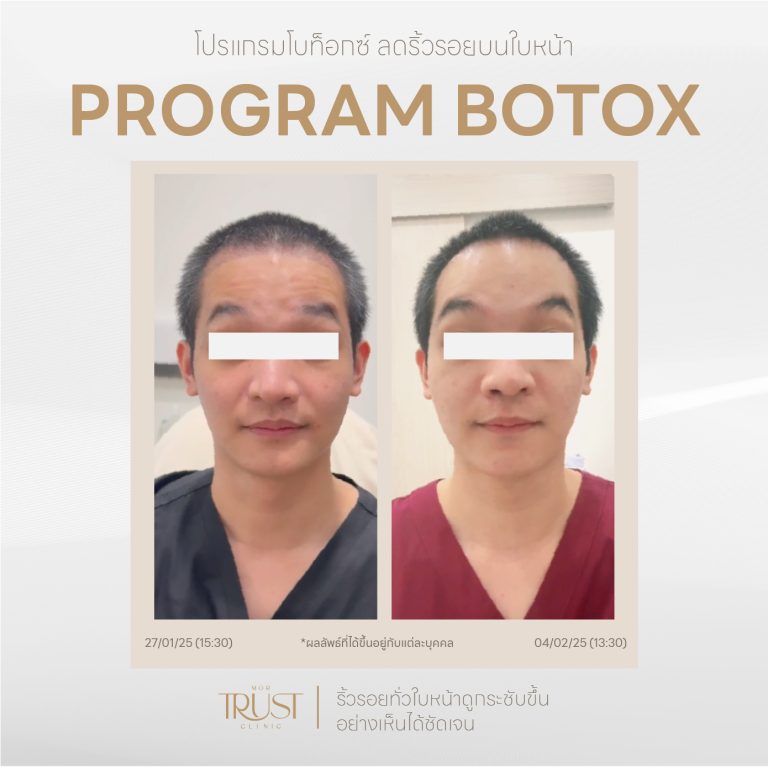 Botox07