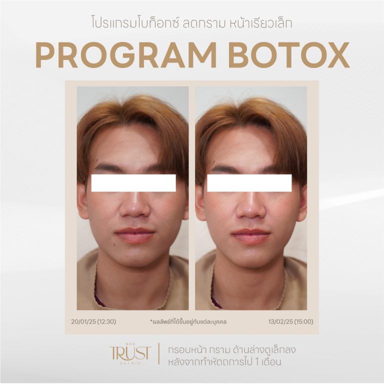 Botox09