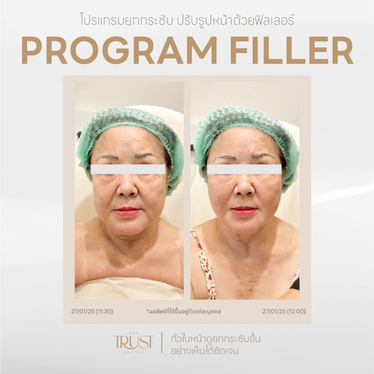 Filler15