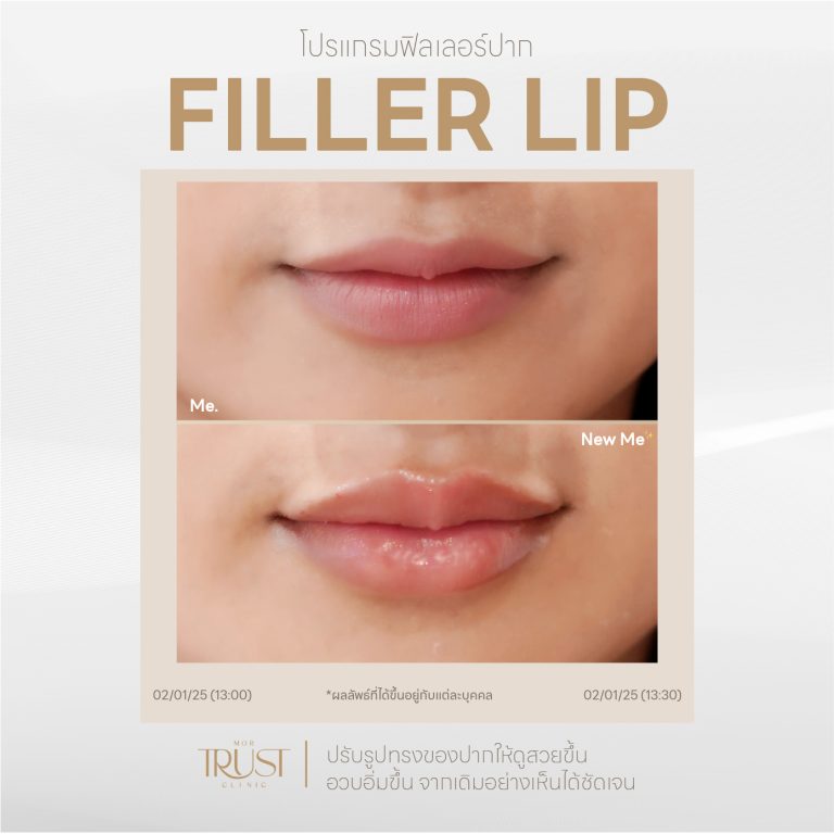 FillerLip01