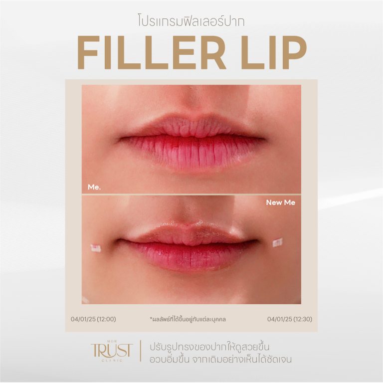 FillerLip02