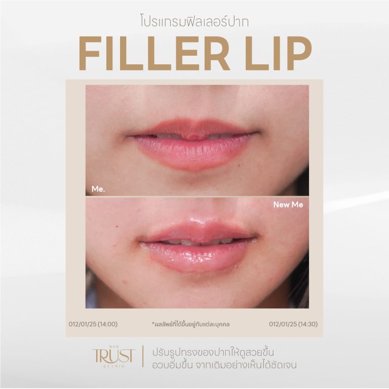 FillerLip03