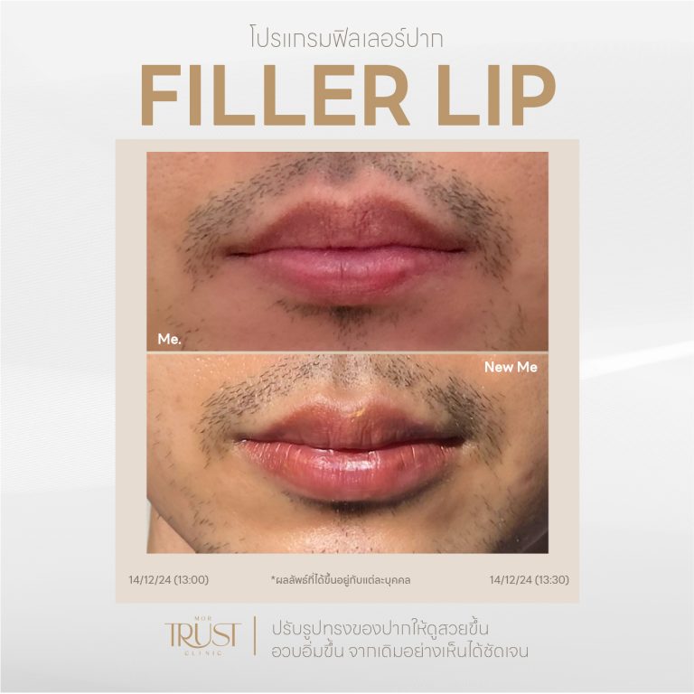 FillerLip05