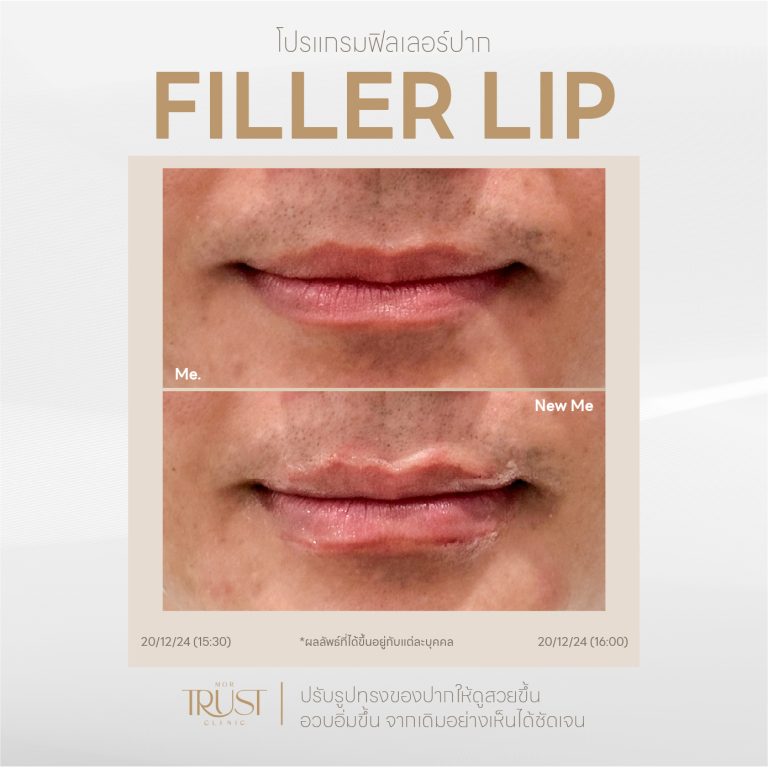 FillerLip06