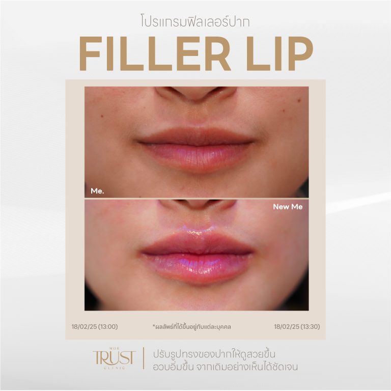 FillerLip08