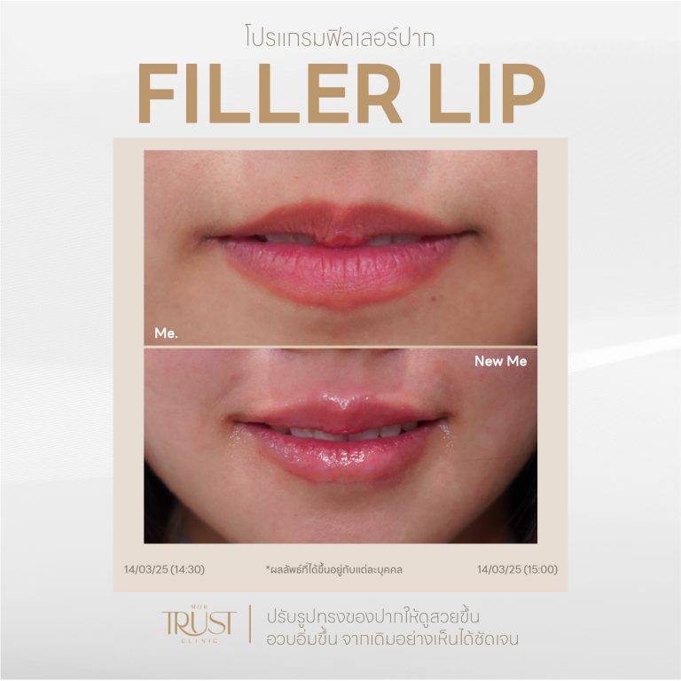 FillerLip09