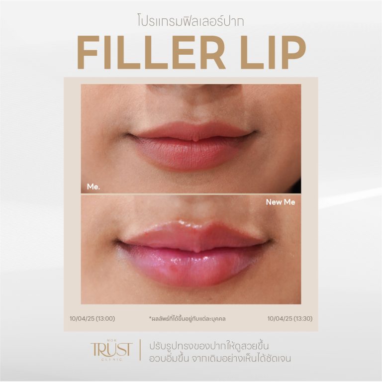 FillerLip10