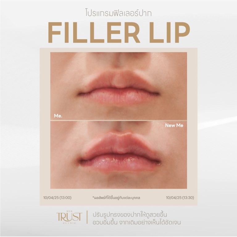 FillerLip11