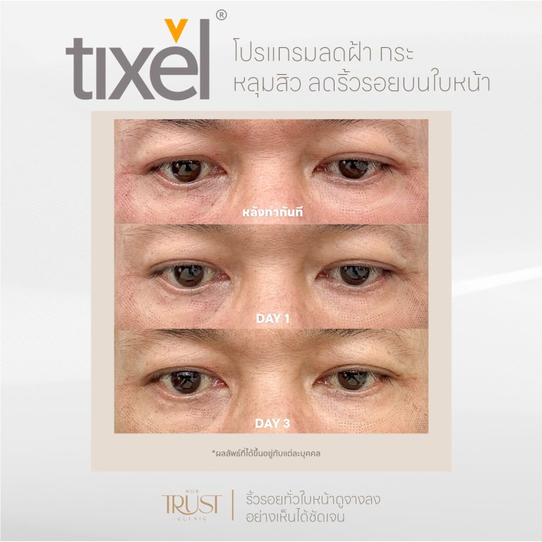 Tixel02