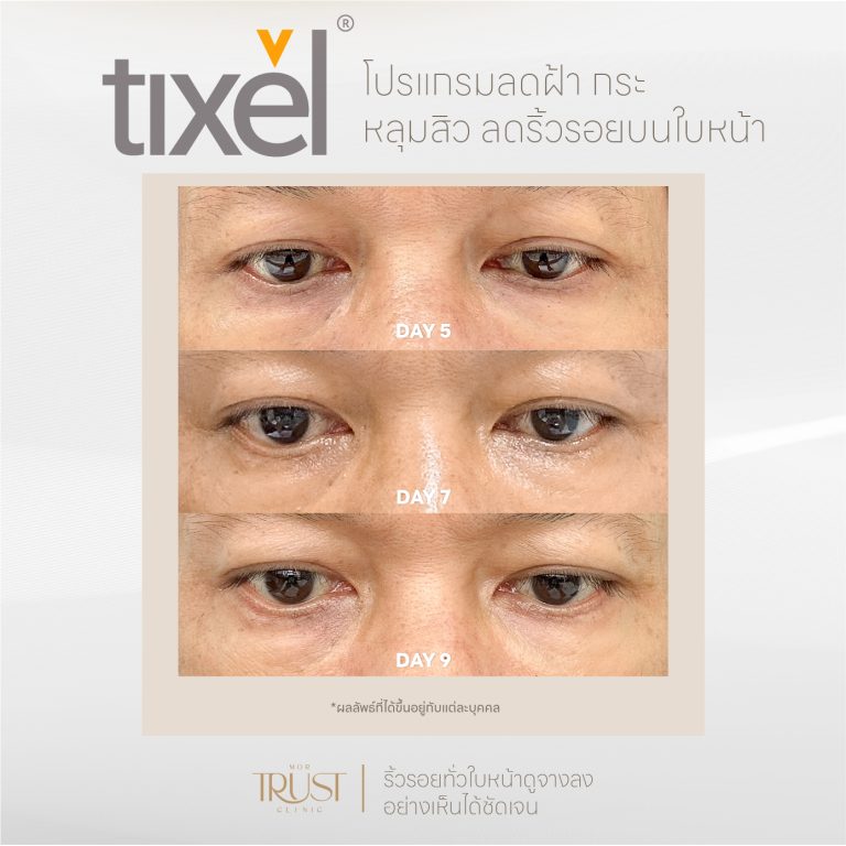 Tixel03