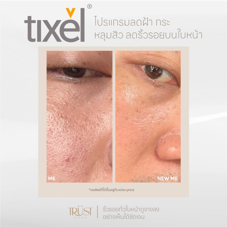 Tixel05