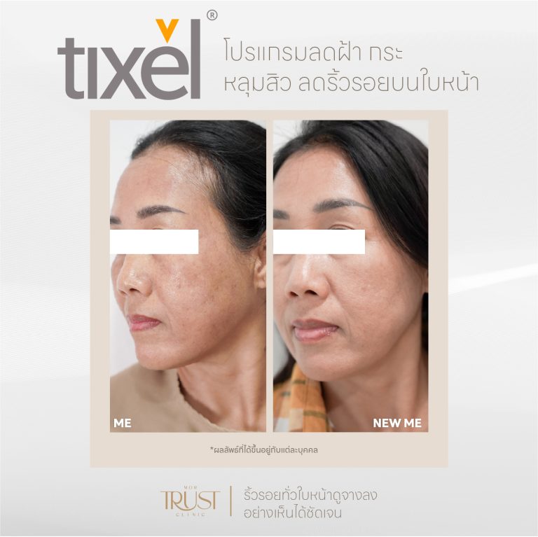 Tixel07