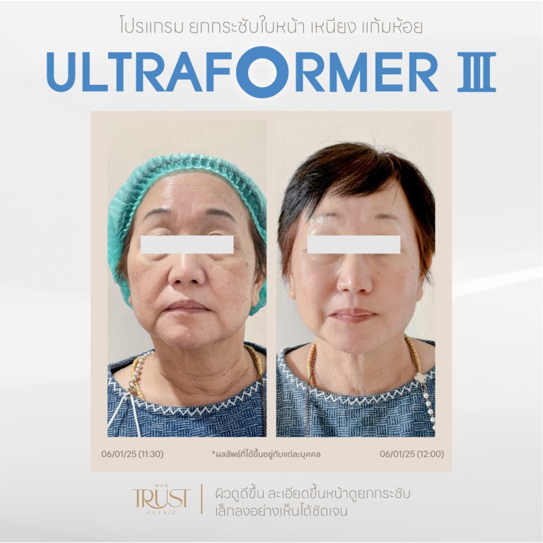 Ultraformer01