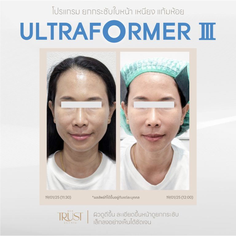 Ultraformer02