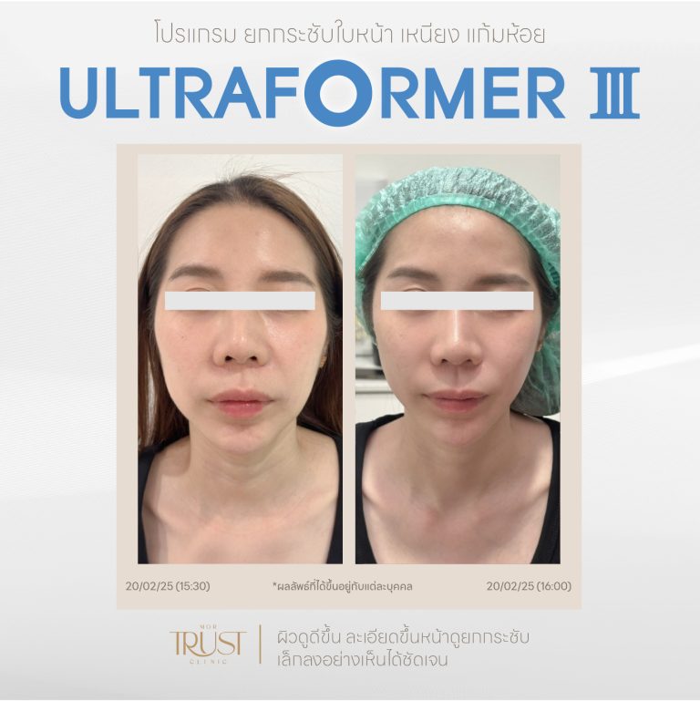 Ultraformer03