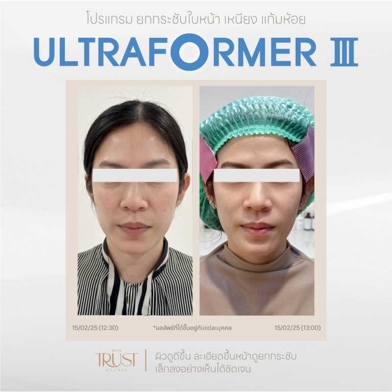 Ultraformer04