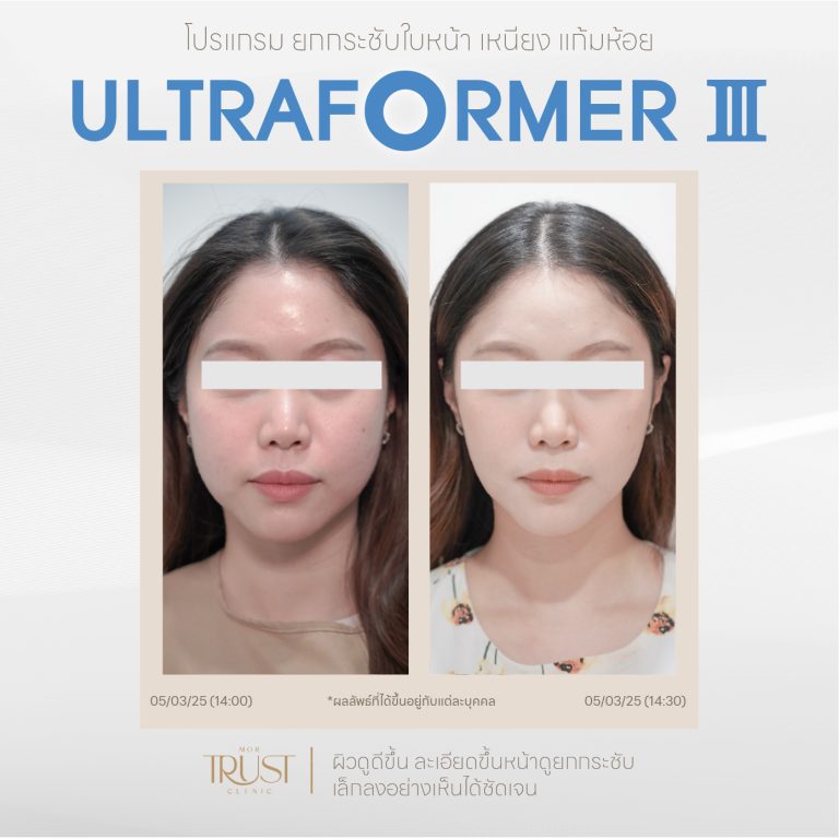 Ultraformer05
