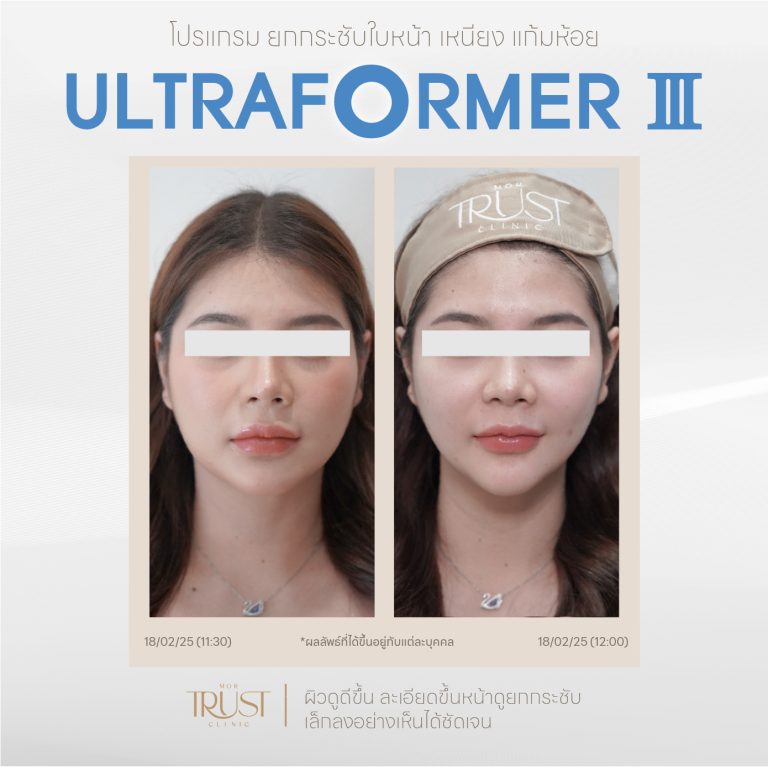 Ultraformer06